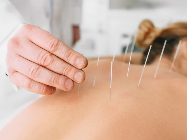 6 beneficios de la acupuntura
